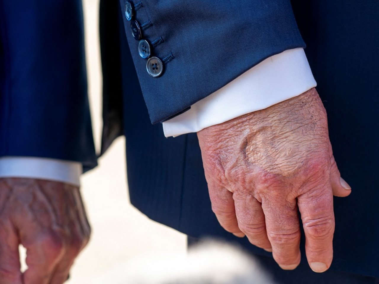 Donald Trump's bruised right hand often appears to be covered in make-up. Photo: Reuters